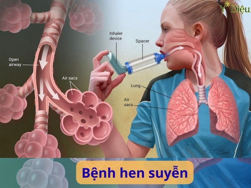 Hen suyễn là gì? Triệu chứng, nguyên nhân và cách phòng ngừa